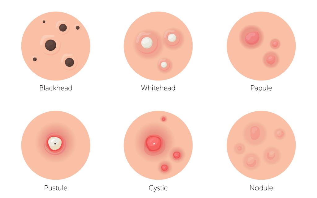Visual diagram of different types of acne