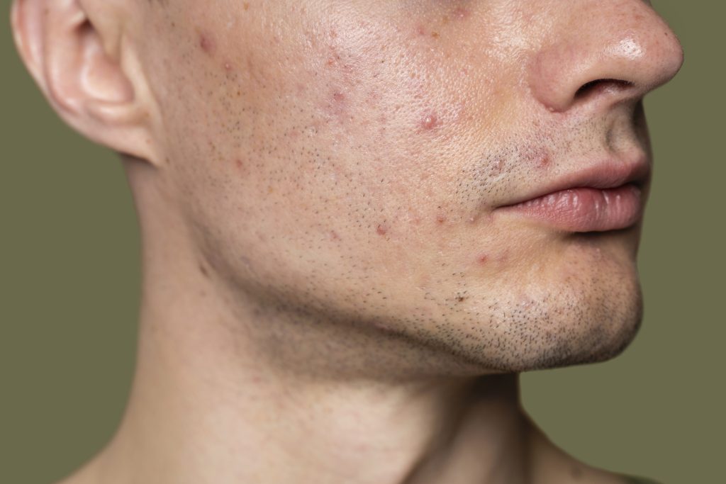 A man with acne-prone, congested skin and a damaged skin barrier