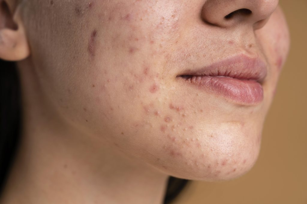 A woman with congested, acne-prone skin. She has redness and scarring, irritation and comedones.